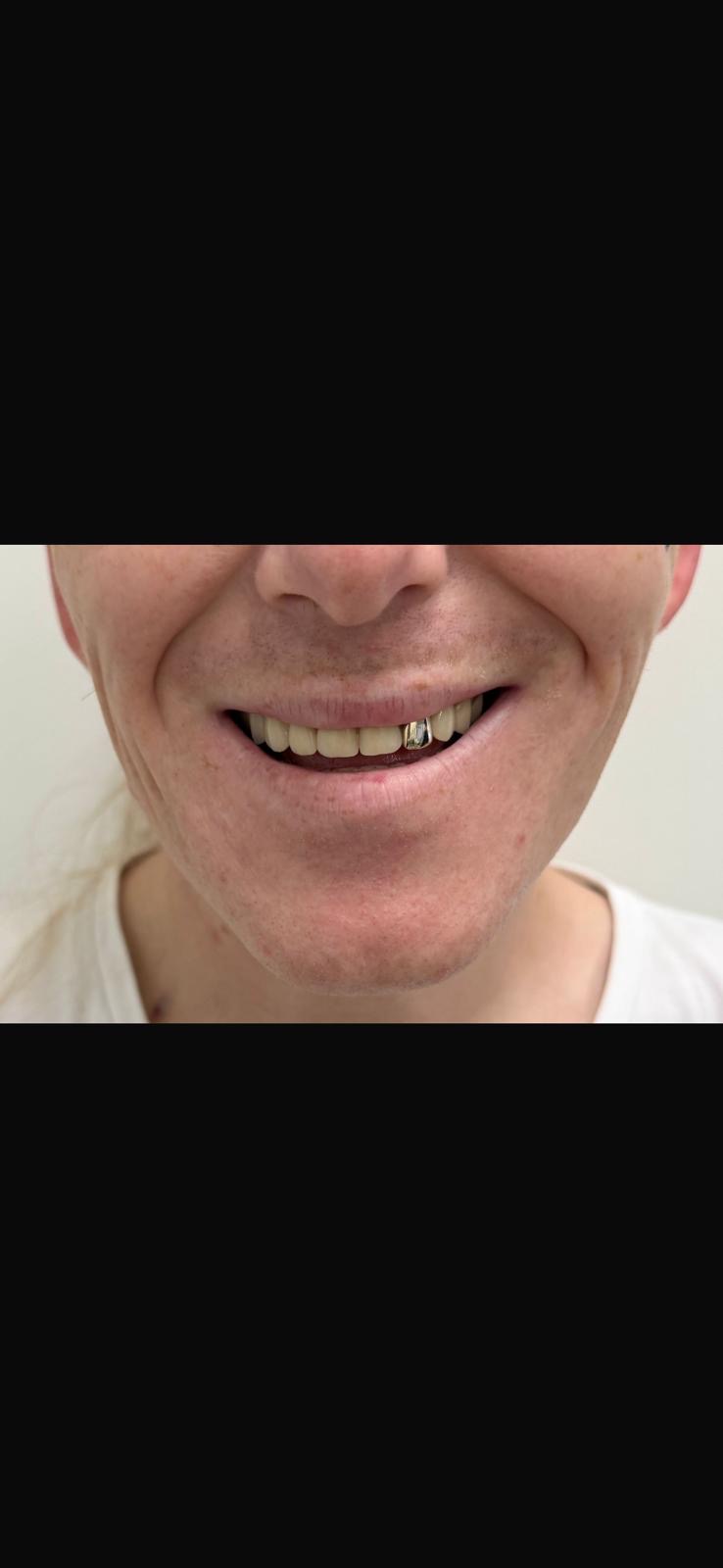 After — Full set after tooth loss