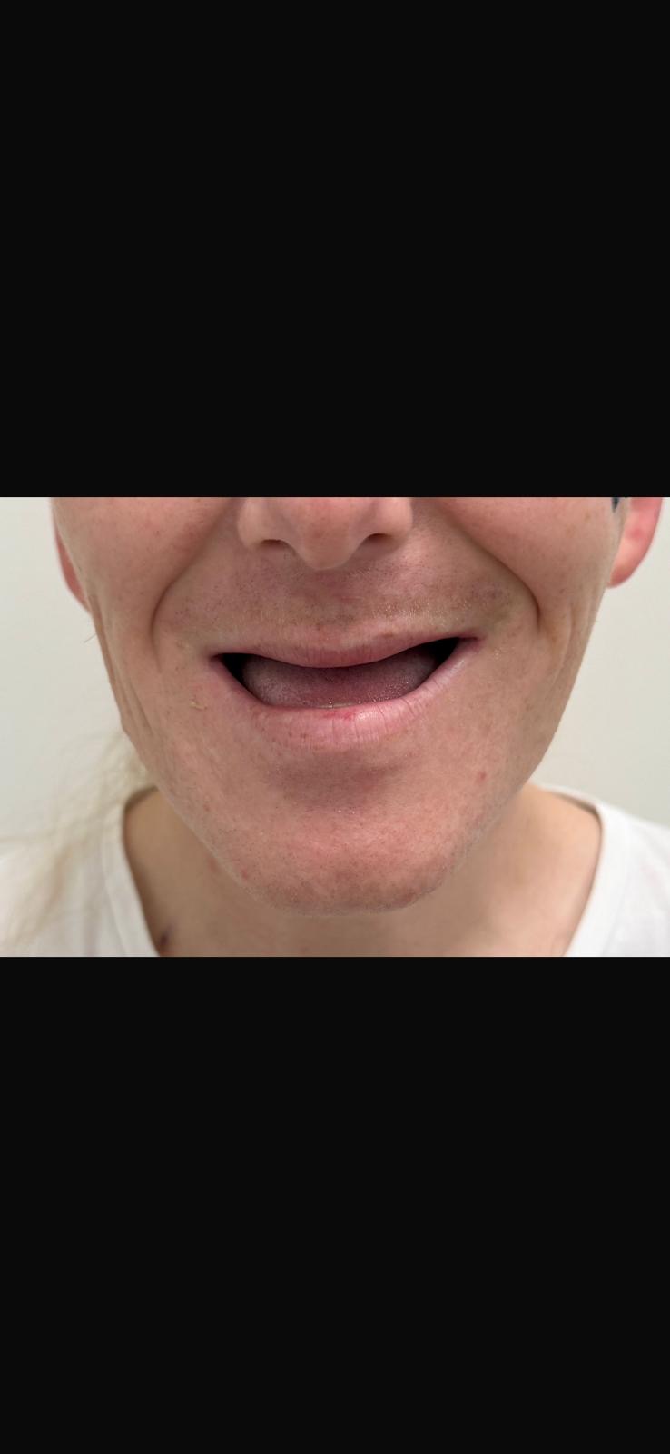 Before — Full set after tooth loss