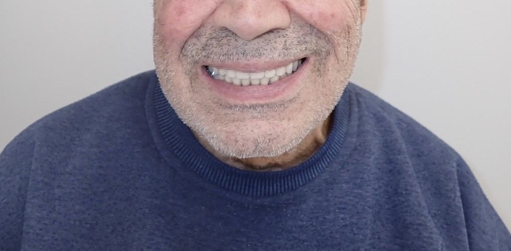 After — Full upper & lower dentures
