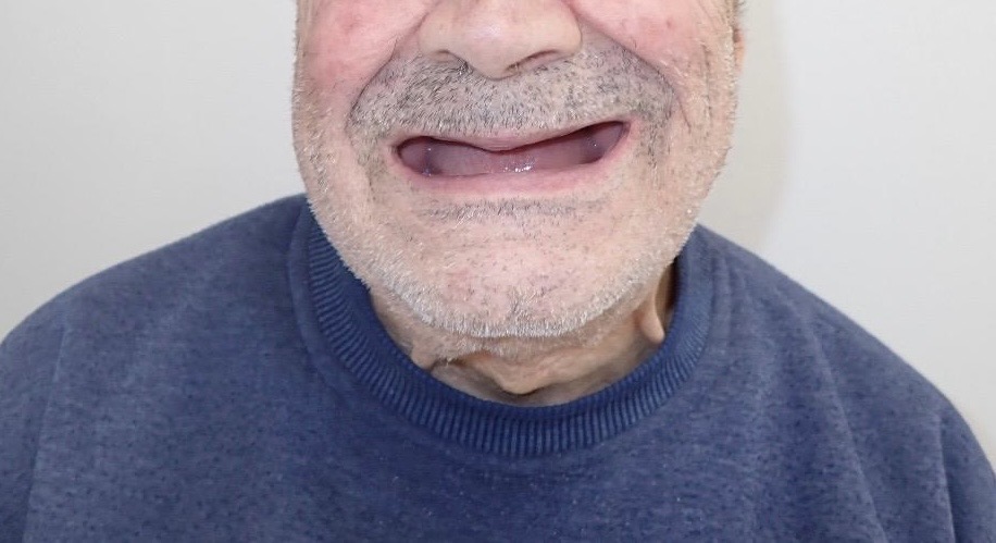 Before — Full upper & lower dentures