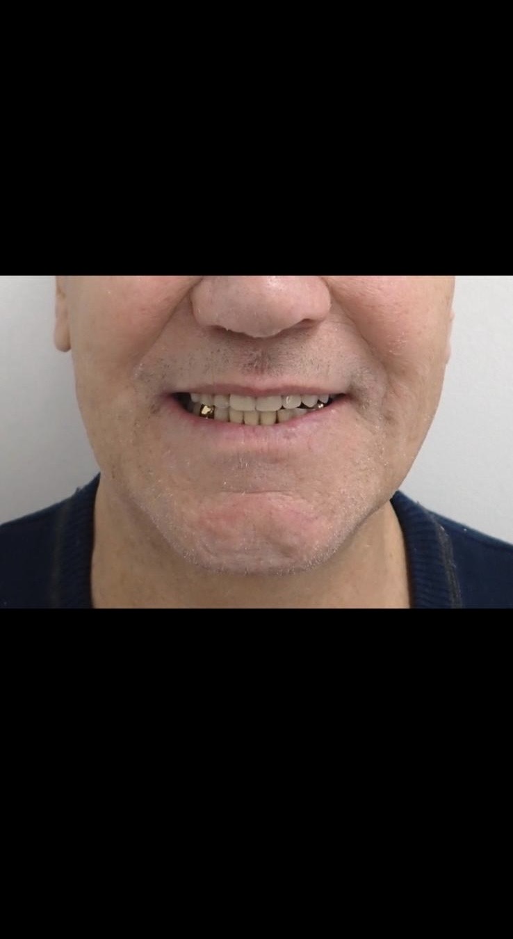 After — Full denture after extractions