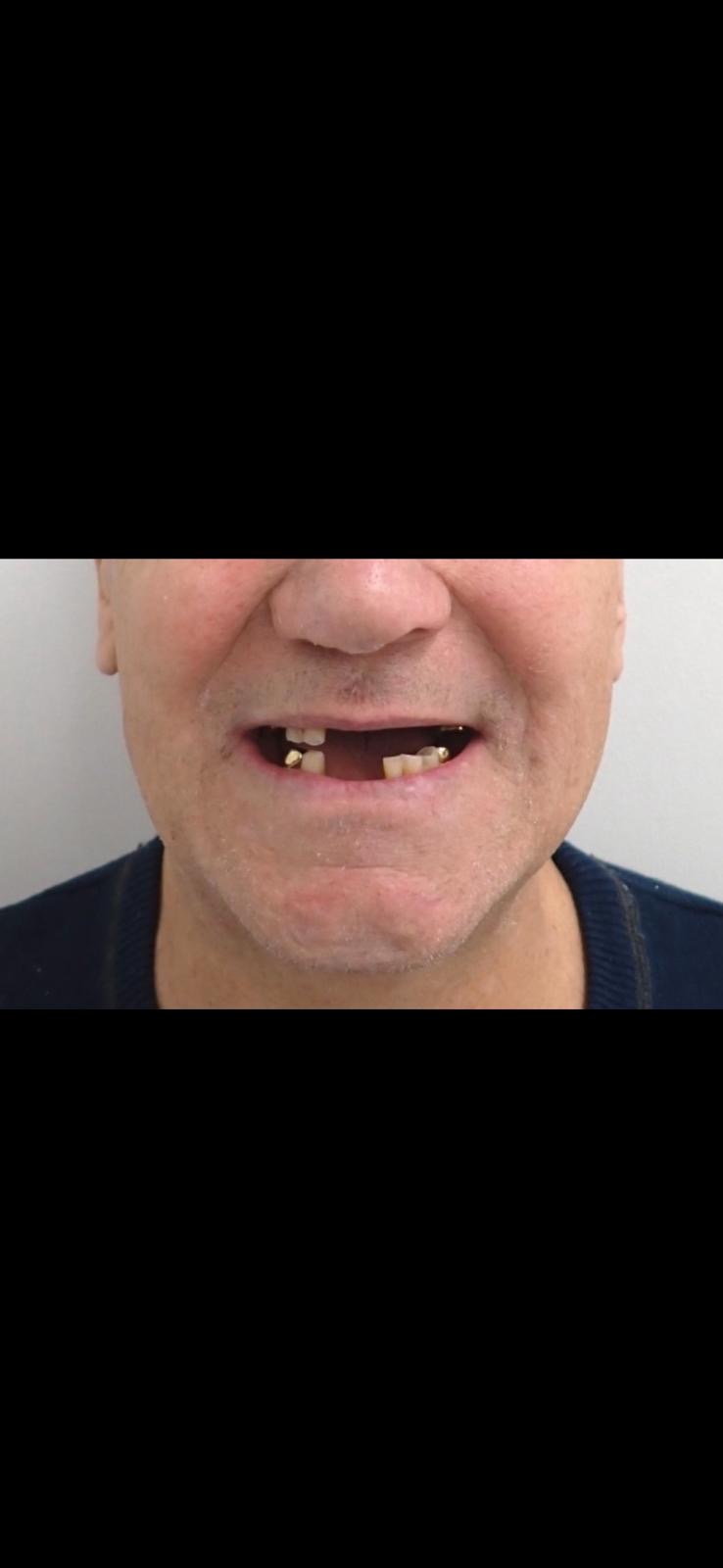 Before — Full denture after extractions