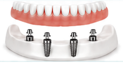 Dentures on Implants, Dentures Direct