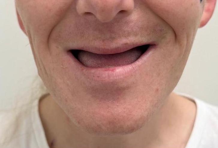 Before, Full set after tooth loss