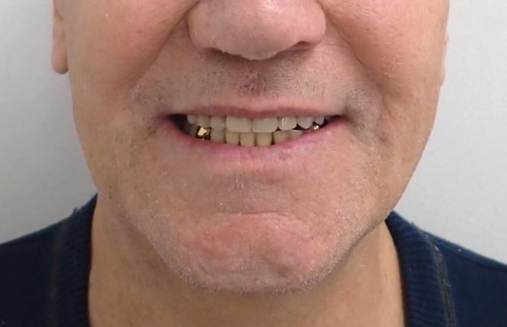After, Partial chrome dentures after extractions