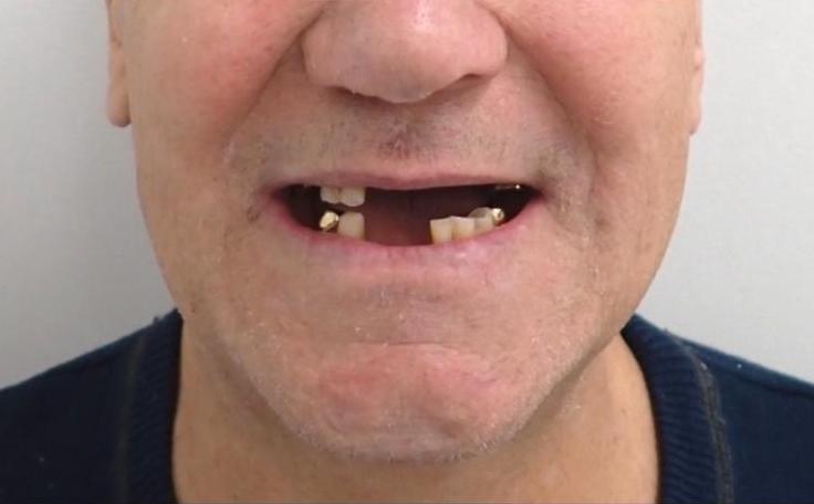 Before, Partial chrome dentures after extractions