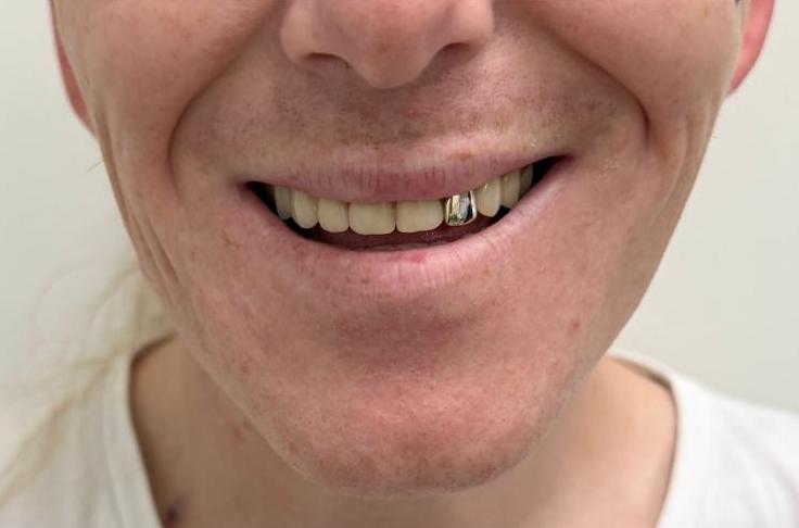 After, Full set after tooth loss
