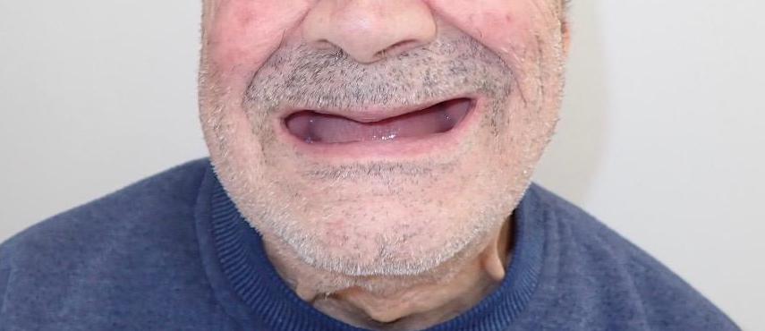 Before, Full upper & lower dentures