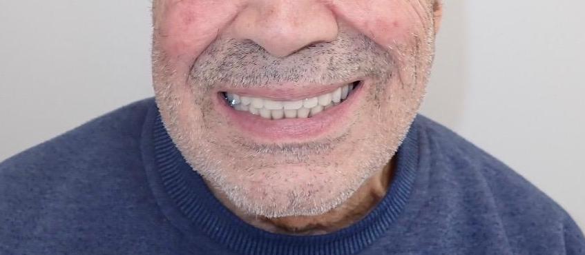 After, Full upper & lower dentures
